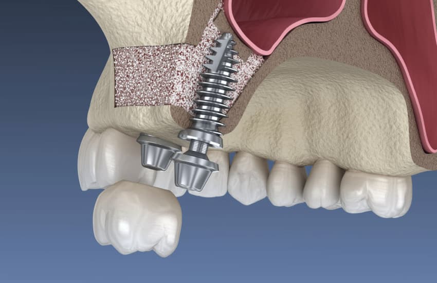 Frenectomy in Cicero, NY - Cicero Dental Associates