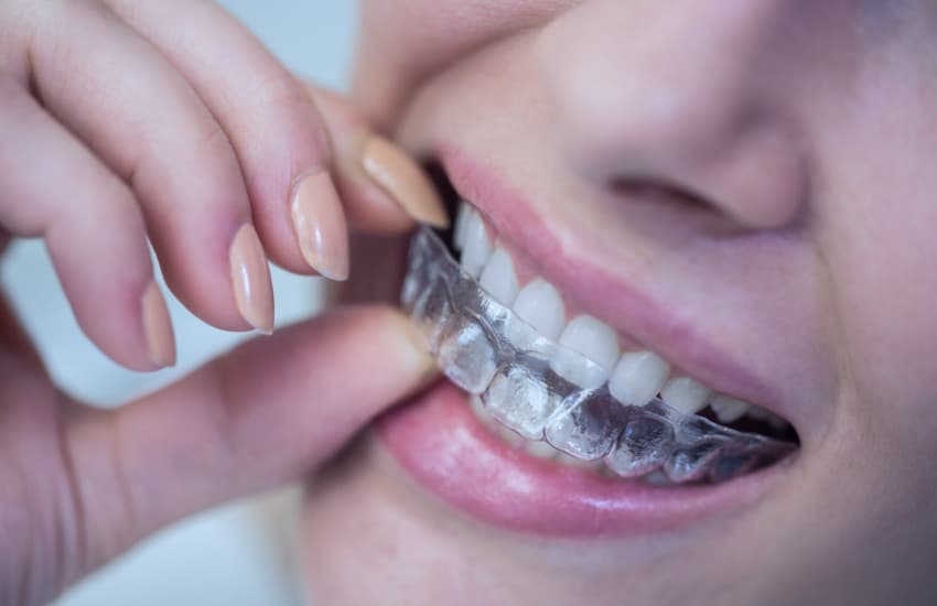 Retainers in Cicero, NY - Cicero Dental Associates