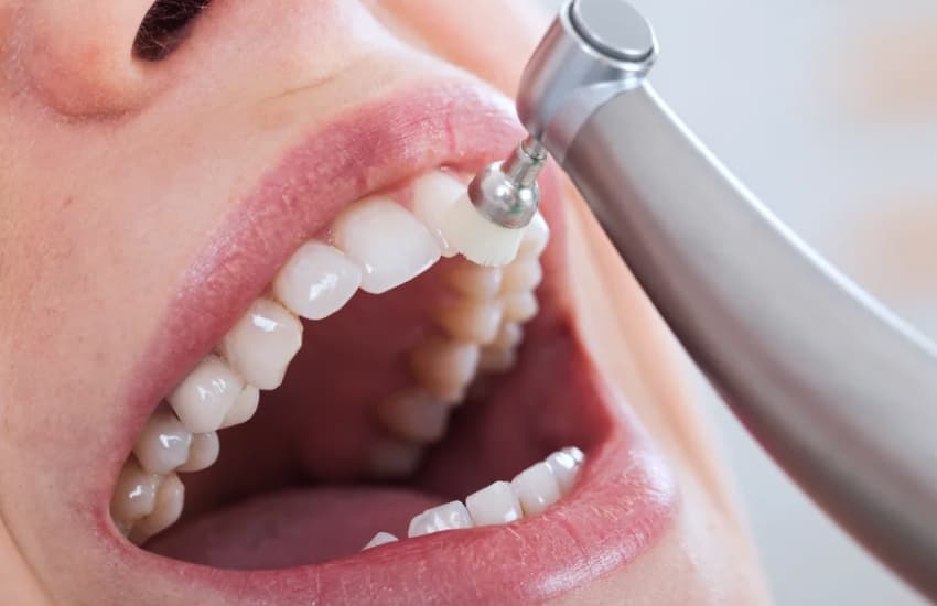 Fluoride Treatments in Cicero, NY - Cicero Dental Associates
