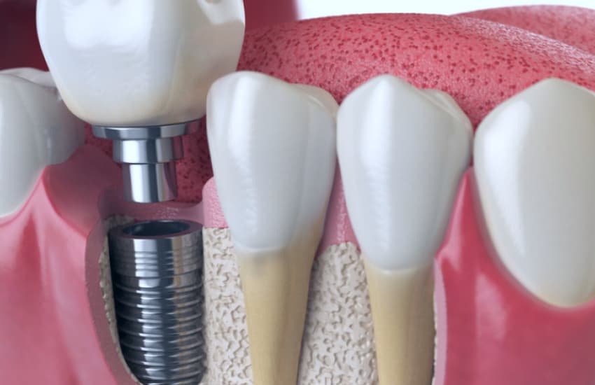 Bone Grafting in Cicero, NY - Cicero Dental Associates