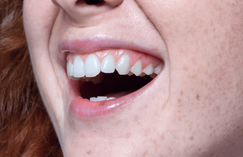 Wisdom Tooth Extractions in Cicero, NY - Cicero Dental Associates