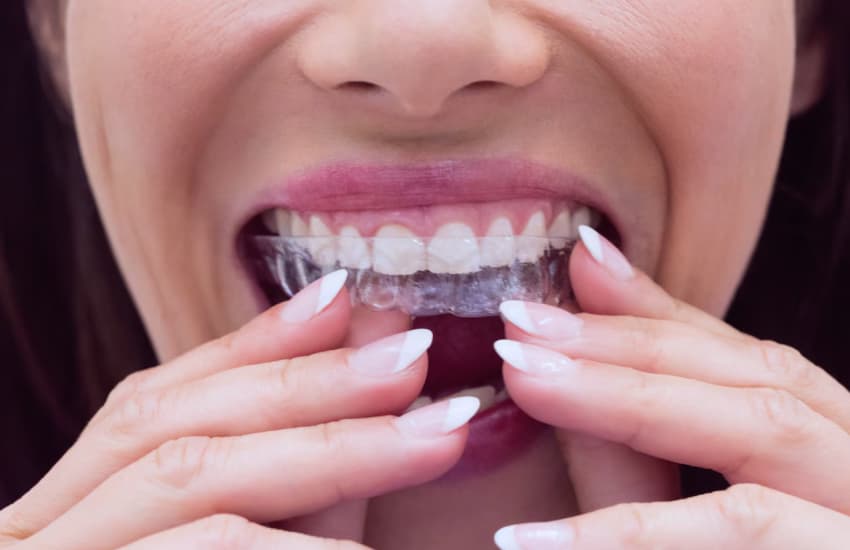 Clear Aligners (Invisalign) in Cicero, NY - Cicero Dental Associates