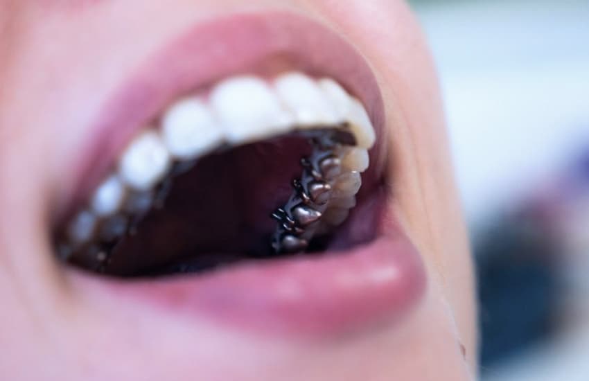 Lingual Braces in Cicero, NY - Cicero Dental Associates