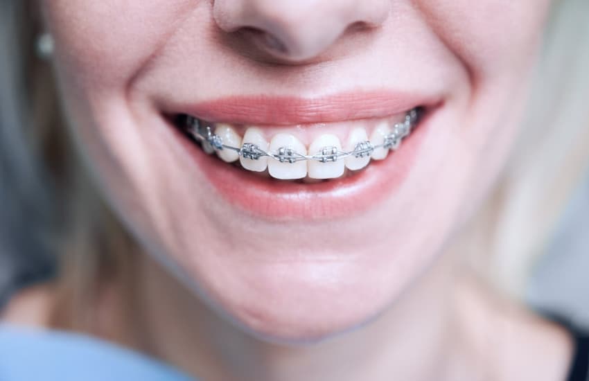 Ceramic Braces in Cicero, NY - Cicero Dental Associates