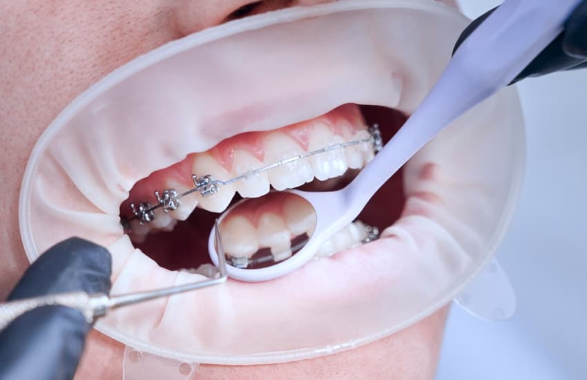 Traditional Metal Braces in Cicero, NY - Cicero Dental Associates